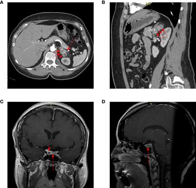 Familial Acromegaly and Bilateral Asynchronous Pheochromocytomas in a Female Patient With a MAX Mutation: A Case Report